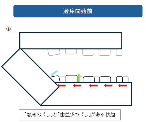 顎変形症治療前の歯並び