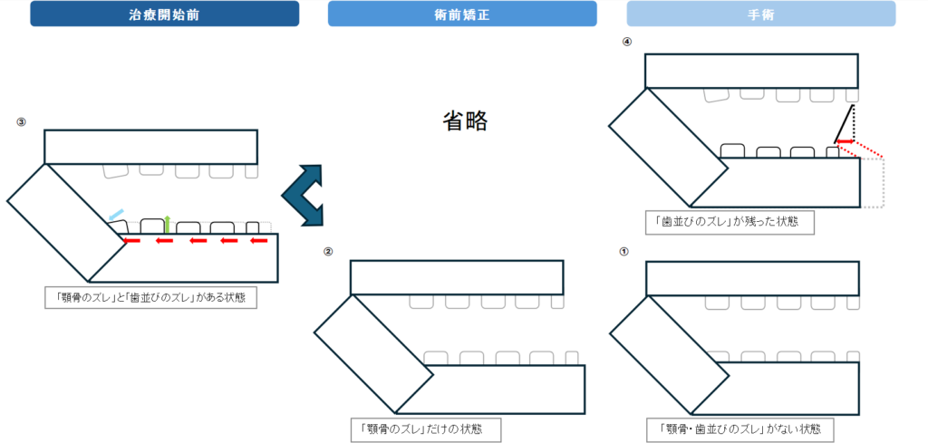 術前矯正をした場合しない場合の顎変形症治療の流れ