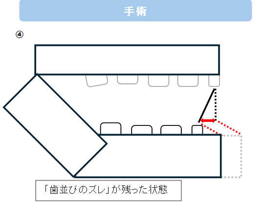 術前矯正をしない場合の手術結果