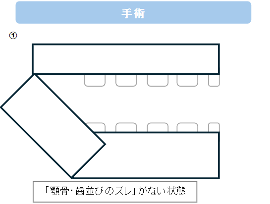 術前矯正した後の手術結果